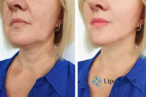 Double chin before and after Hi-Fu treatment 4 Book your double chin treatment Brighton and Hove today! We are here to help!