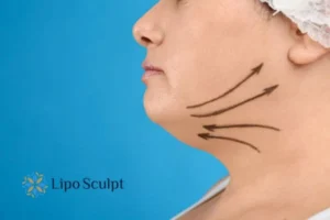 Double chin before and after Hi-Fu treatment 3 Boost your confidence with a Double chin treatment Brighton and Hove