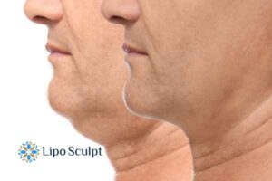 Double chin before and after Hi-Fu treatment 2 Double chin treatment Brighton and Hove from Lipo Sculpt - feel more confident today!