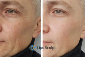 How to Fight Aging Symptoms 3 Fight Aging Symptoms Brighton and Hove With HIFU and Morpheus8 Today!