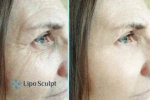 How to Fight Aging Symptoms 2 Do you want to Fight Aging Symptoms Brighton and Hove? Contact Lipo Sculpt today!