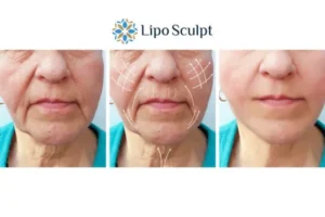 Explaining Morpheus8 And What It Can Do For You 3 Boost your confidence with Morpheus8 Brighton and Hove call our team today!