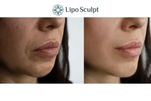 Explaining Morpheus8 And What It Can Do For You 4 Morpheus8 Brighton and Hove the best results - call our team today!