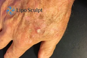 Best Actinic Keratoses Removal 2 Improve your wellbeing and health with Actinic Keratoses Brighton and Hove removal.treatment