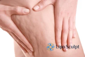 CoolSculpting for Legs: The Innovative Approach to Redefining Your Legs 5 Start your journey today book your coolsculpting treatment Brighton and Hove online today!