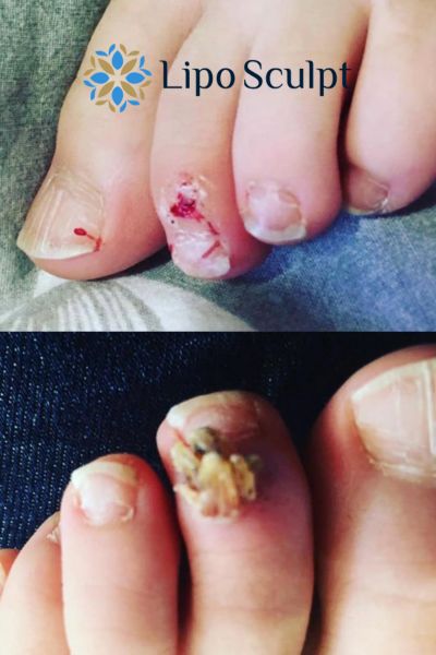 Wart removal customer results from Lipo Sculpt Brighton and Hove