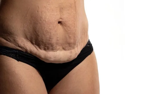 Lost the Weight but Not the Loose Skin? 1 image of womans stomach after weight loss showing loose skin Brighton and Hove